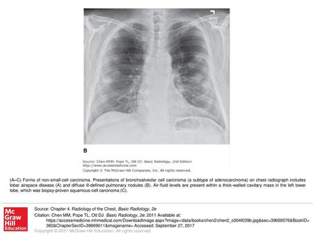 (A–C) Forms of non-small-cell carcinoma