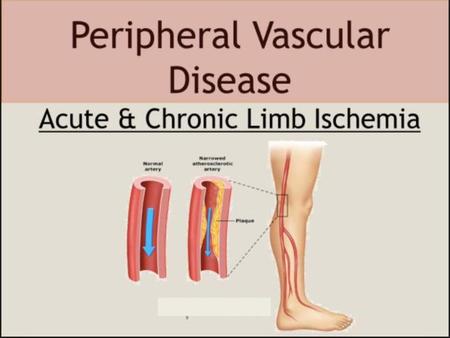 Peripheral Arterial Disease Admissions CLI AND PAD ADMISSIONS.