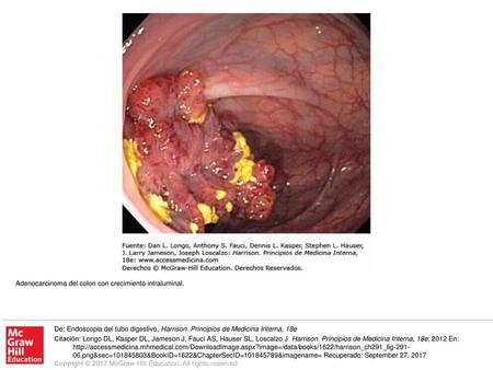 Adenocarcinoma del colon con crecimiento intraluminal.