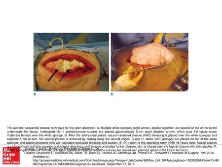 The authors’ sequential closure technique for the open abdomen. A