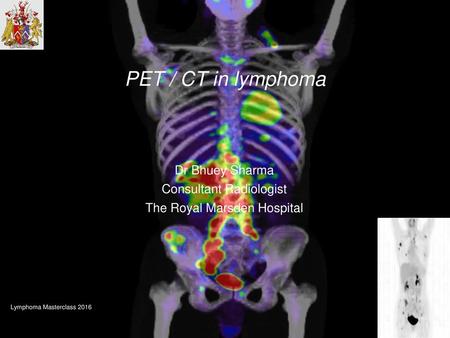 PET / CT in lymphoma Dr Bhuey Sharma Consultant Radiologist