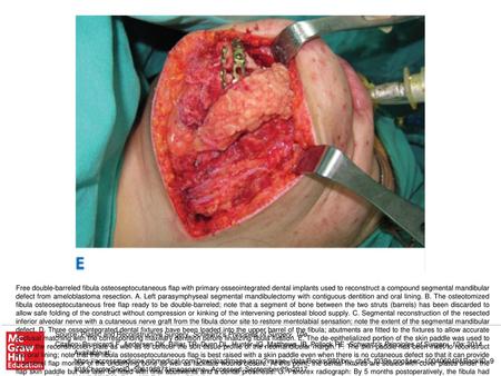 Free double-barreled fibula osteoseptocutaneous flap with primary osseointegrated dental implants used to reconstruct a compound segmental mandibular defect.