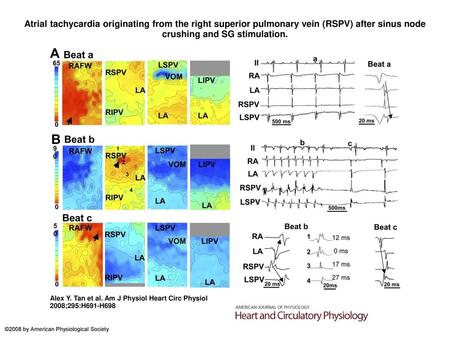 Atrial tachycardia originating from the right superior pulmonary vein (RSPV) after sinus node crushing and SG stimulation. Atrial tachycardia originating.