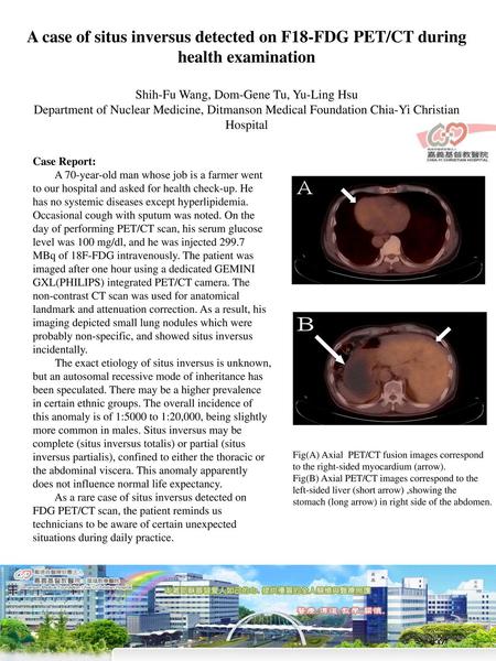 A case of situs inversus detected on F18-FDG PET/CT during health examination Shih-Fu Wang, Dom-Gene Tu, Yu-Ling Hsu Department of Nuclear Medicine, Ditmanson.