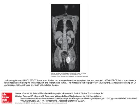 18 F-deoxyglucose (18FDG) PET/CT fusion scan