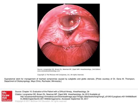 Suprastomal stent for management of tracheal compromise caused by subglottic and glottic stenosis. [Photo courtesy of Dr. Dana M. Thompson, Department.