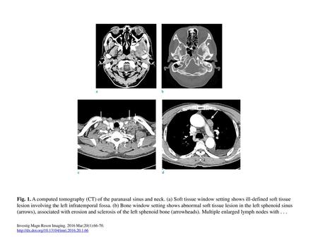 Fig. 1. A computed tomography (CT) of the paranasal sinus and neck