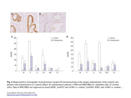 Fig. 3. Representative micrographs of progesterone receptor-B immunostaining in the eutopic endometrium of the controls and patients with endometriosis.