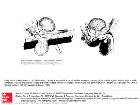 Injury to the bulbous urethra