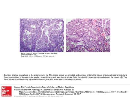 Complex atypical hyperplasia of the endometrium