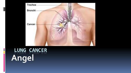 Lung Cancer Angel.