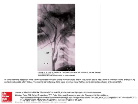 In a more severe dissection there can be complete occlusion of the internal carotid artery. The patient above has a normal common carotid artery (CCA)