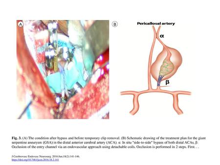 Fig. 3. (A) The condition after bypass and before temporary clip removal. (B) Schematic drawing of the treatment plan for the giant serpentine aneurysm.