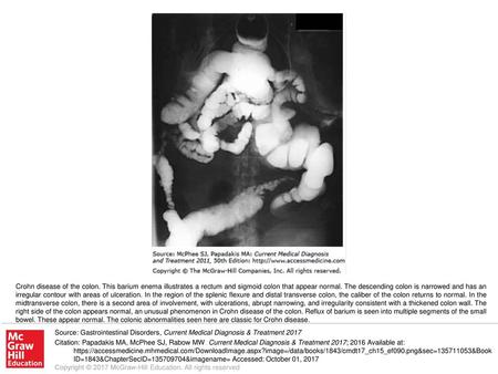 Crohn disease of the colon