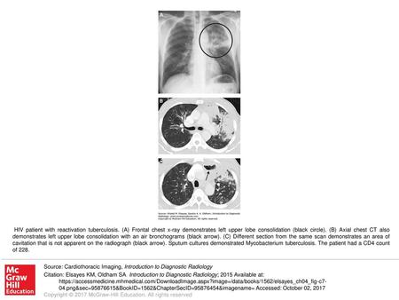 HIV patient with reactivation tuberculosis