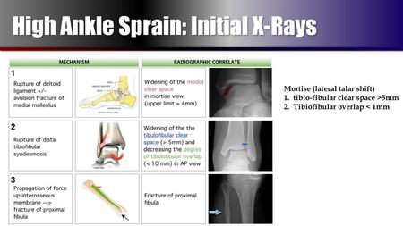 High Ankle Sprain: Initial X-Rays