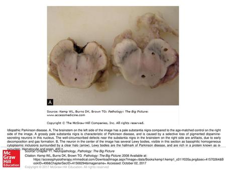 Idiopathic Parkinson disease