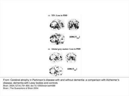 Fig. 1 The effects of modelling global volume for the analysis of PDD relative to controls. Atrophy in PDD shown (A) compensated for differences in head.