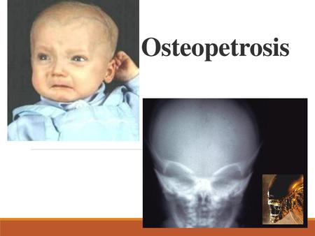 Osteopetrosis.