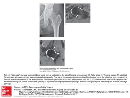 FAI. (A) Radiograph shows a prominent bone bump (arrow) just distal to the lateral femoral physeal scar. (B) Alpha angle in FAI. Axial oblique T1-weighted.