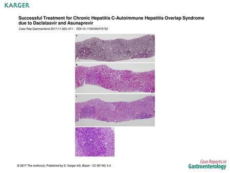 Successful Treatment for Chronic Hepatitis C-Autoimmune Hepatitis Overlap Syndrome due to Daclatasvir and Asunaprevir Case Rep Gastroenterol 2017;11:305–311.