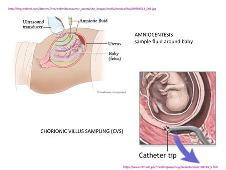 AMNIOCENTESIS sample fluid around baby