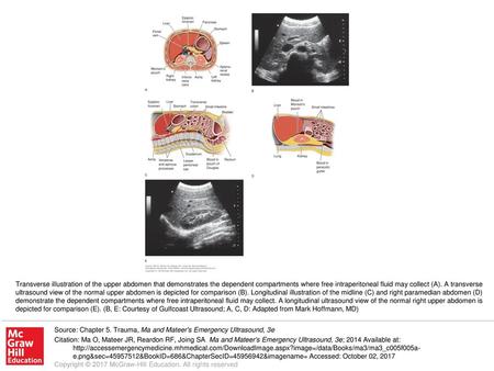 Transverse illustration of the upper abdomen that demonstrates the dependent compartments where free intraperitoneal fluid may collect (A). A transverse.