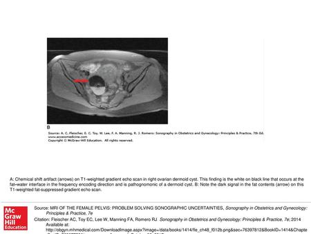 A: Chemical shift artifact (arrows) on T1-weighted gradient echo scan in right ovarian dermoid cyst. This finding is the white on black line that occurs.