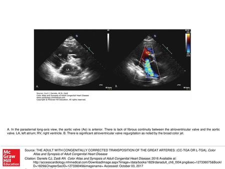 A. In the parasternal long-axis view, the aortic valve (Ao) is anterior. There is lack of fibrous continuity between the atrioventricular valve and the.