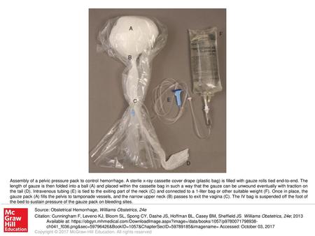 Assembly of a pelvic pressure pack to control hemorrhage