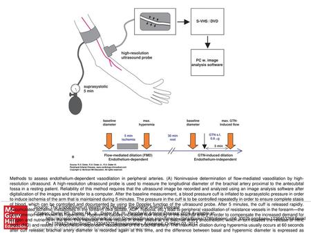 Methods to assess endothelium-dependent vasodilation in peripheral arteries. (A) Noninvasive determination of flow-mediated vasodilation by high-resolution.