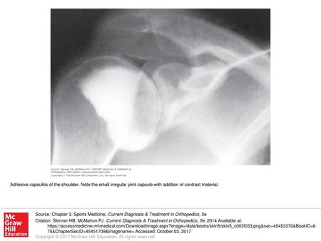 Adhesive capsulitis of the shoulder