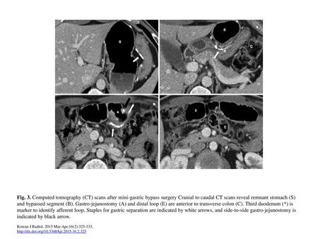 Fig. 3. Computed tomography (CT) scans after mini-gastric bypass surgery Cranial to caudal CT scans reveal remnant stomach (S) and bypassed segment (B).