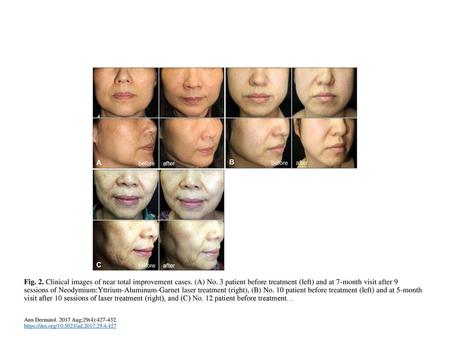 Fig. 2. Clinical images of near total improvement cases. (A) No