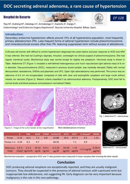 DOC secreting adrenal adenoma, a rare cause of hypertension