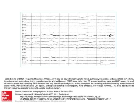 Scalp Edema and High Frequency Respirator Artifacts