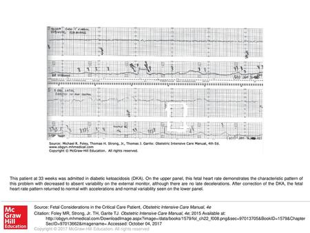 This patient at 33 weeks was admitted in diabetic ketoacidosis (DKA)