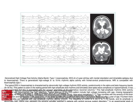 The EEG features and their evolution change with age