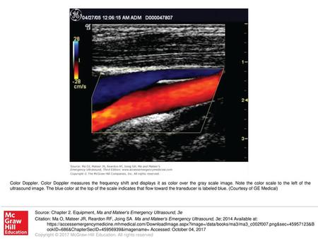 Color Doppler. Color Doppler measures the frequency shift and displays it as color over the gray scale image. Note the color scale to the left of the ultrasound.