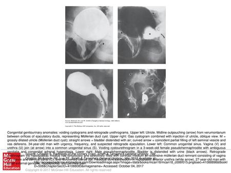 Congenital genitourinary anomalies: voiding cystograms and retrograde urethrograms. Upper left: Utricle. Midline outpouching (arrow) from verumontanum.