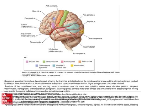 Paralysis of conjugate gaze to the opposite side: Frontal contraversive eye field or projecting fibers Source: Cerebrovascular Diseases, Harrison's Principles.