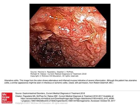 Ulcerative colitis. This image from the colon shows edematous and inflamed mucosa indicative of severe inflammation. Although this patient has ulcerative.