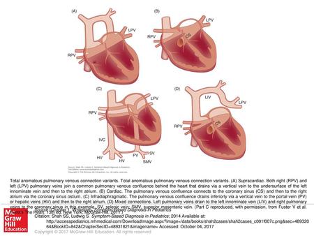 Total anomalous pulmonary venous connection variants