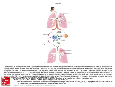 Tuberculosis. A. Primary tuberculosis