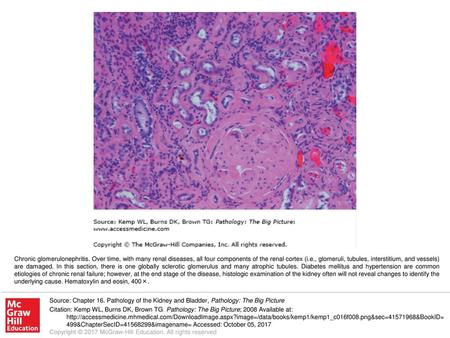 Chronic glomerulonephritis