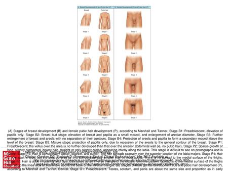 (A) Stages of breast development (B) and female pubic hair development (P), according to Marshall and Tanner. Stage B1: Preadolescent; elevation of papilla.