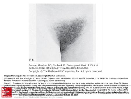 Stage P1: Preadolescent; the vellus over the area is no further developed than that over the anterior abdominal wall (ie, no pubic hair). Stage P2: Sparse.