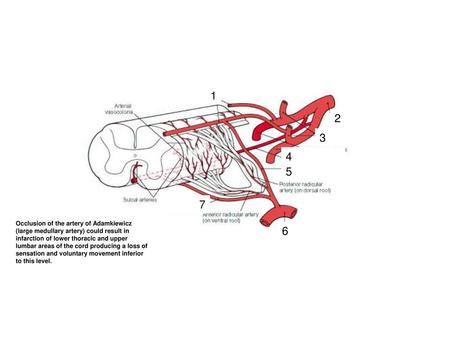 1 2 3 4 5 7 Occlusion of the artery of Adamkiewicz (large medullary artery) could result in infarction of lower thoracic and upper lumbar areas of the.