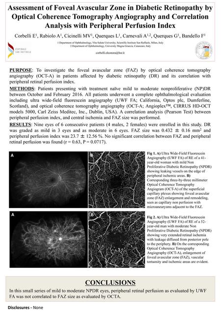 Assessment of Foveal Avascular Zone in Diabetic Retinopathy by Optical Coherence Tomography Angiography and Correlation Analysis with Peripheral Perfusion.