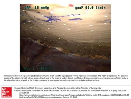 Intraperitoneal view of expanded polytetrafluoroethylene mesh used for laparoscopic ventral incisional hernia repair. The mesh is in place on the posterior.